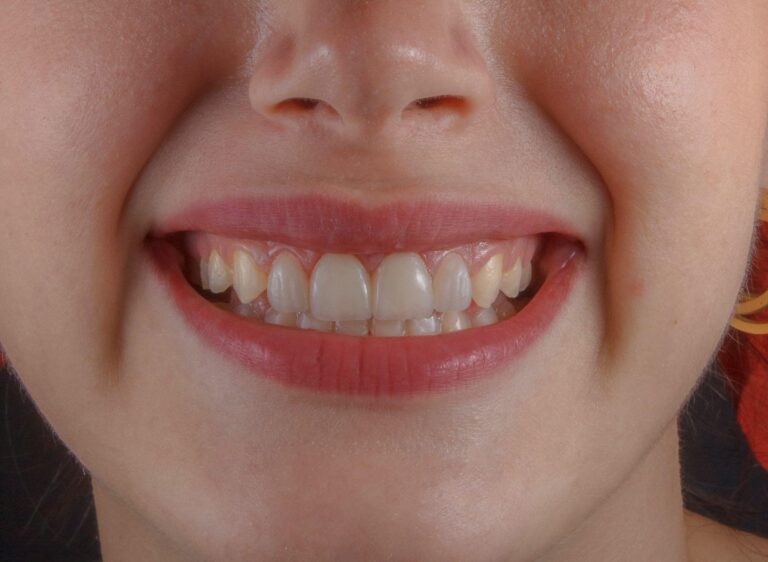 The Life-Changing Benefits of Dental Implants That Go Beyond Your Smile